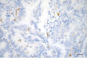 Immunohistochemistry was performed on paraffin-embedded human endometrial carcinoma using phospho-vimentin (S39) antibody (ABIN7800837), 1:200). (Recombinant Vimentin 抗体  (pSer39))