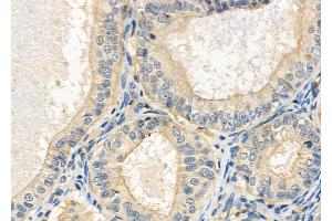 ABIN6264184 and ABIN6272389 at 1/100 staining Human ovarian cancer and adjacent normal tissues by IHC-P. (OLFML2B 抗体  (Internal Region))
