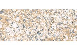 Immunohistochemistry of paraffin-embedded Human liver cancer tissue using DNAJA4 Polyclonal Antibody at dilution of 1:55(x200) (DNAJA4 抗体)