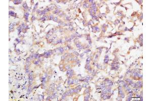 Formalin-fixed and paraffin embedded human lung cancer labeled with Rabbit Anti-TRIB2 Polyclonal Antibody, Unconjugated  at 1:200 followed by conjugation to the secondary antibody and DAB staining (TRIB2 抗体  (AA 151-250))
