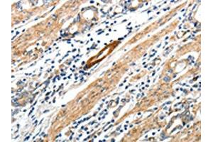 The image on the left is immunohistochemistry of paraffin-embedded Human gastric cancer tissue using ABIN7192673(STEAP4 Antibody) at dilution 1/25, on the right is treated with synthetic peptide. (STEAP4 抗体)