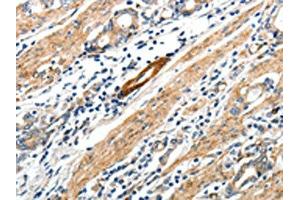 The image on the left is immunohistochemistry of paraffin-embedded Human gastric cancer tissue using ABIN7192673(STEAP4 Antibody) at dilution 1/25, on the right is treated with synthetic peptide. (STEAP4 抗体)