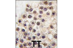 Formalin-fixed and paraffin-embedded human testis tissue reacted with ARIDB3 antibody , which was peroxidase-conjugated to the secondary antibody, followed by DAB staining. (ARID3B 抗体  (C-Term))