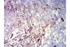 Immunohistochemical analysis of paraffin-embedded bladder cancer tissues using CD44 mouse mAb with DAB staining. (CD44 抗体  (AA 36-194))