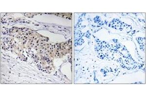 Immunohistochemistry analysis of paraffin-embedded human breast carcinoma tissue, using NDUFA3 Antibody. (NDUFA3 抗体  (AA 34-83))