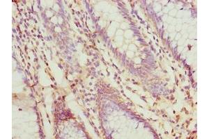 Immunohistochemistry of paraffin-embedded human colon cancer using ABIN7156187 at dilution of 1:100 (PRSS35 抗体  (AA 201-413))
