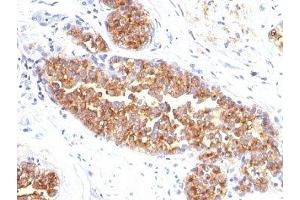 Formalin-fixed, paraffin-embedded human breast carcinoma stained with MUC1 / EMA antibody (MUC1/845). (MUC1 抗体)