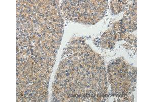 Immunohistochemistry of Human liver cancer using BIRC5 Polyclonal Antibody at dilution of 1:25 (Survivin 抗体)