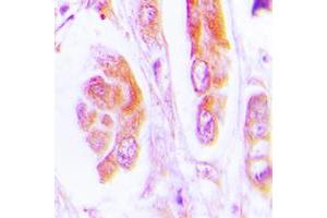Immunohistochemical analysis of Caspase 7 staining in human lung cancer formalin fixed paraffin embedded tissue section.