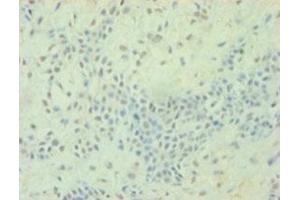 Immunohistochemistry of paraffin-embedded human breast cancer using ABIN7172823 at dilution of 1:100 (TGFB2 抗体  (AA 304-413))