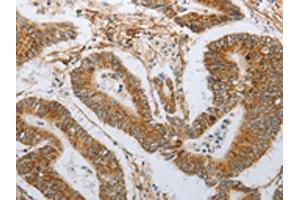 The image on the left is immunohistochemistry of paraffin-embedded Human colon cancer tissue using ABIN7191632(NEUROG1 Antibody) at dilution 1/25, on the right is treated with synthetic peptide. (Neurogenin 1 抗体)