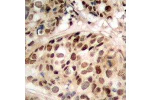 Immunohistochemical analysis of PHF1 staining in human prostate cancer formalin fixed paraffin embedded tissue section. (PHF1 抗体)