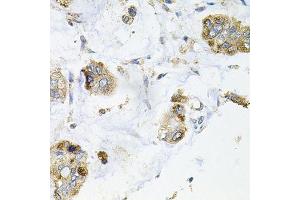Immunohistochemistry of paraffin-embedded human gastric cancer using GALC antibody. (GALC 抗体  (AA 40-300))