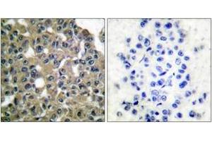 Immunohistochemistry analysis of paraffin-embedded human breast carcinoma tissue, using MAGE-1 Antibody. (MAGEA1 抗体  (AA 260-309))