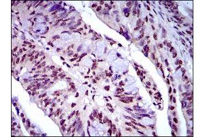 Immunohistochemical analysis of paraffin-embedded rectum cancer tissues using NAPSA mouse mAb with DAB staining.