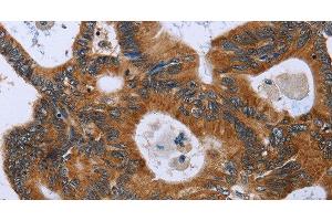 Immunohistochemistry of paraffin-embedded Human colon cancer using GH2 Polyclonal Antibody at dilution of 1:40 (Growth Hormone 2 抗体)