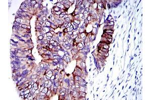 Immunohistochemical analysis of paraffin-embedded human colon cancer tissues using KRT19 mouse mAb with DAB staining. (Cytokeratin 19 抗体)
