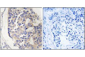 Immunohistochemistry analysis of paraffin-embedded human breast carcinoma tissue, using C1S antibody.