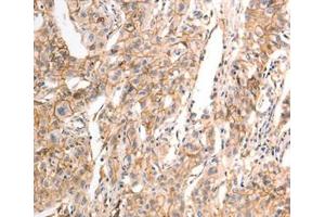 Immunohistochemical analysis of paraffin-embedded Human liver cancer tissue using at dilution 1/30. (CDH23 抗体  (C-Term))