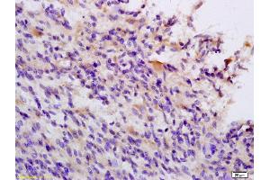 Formalin-fixed and paraffin embedded human brain glioblastoma labeled with Anti TIEG1/KLF10 Polyclonal Antibody, Unconjugated (ABIN735173) at 1:200 followed by conjugation to the secondary antibody and DAB staining (KLF10/TIEG1 抗体  (AA 423-480))