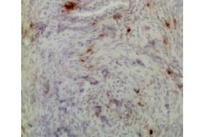Frozen chicken ovarian tumor section was stained with Mouse Anti-Chicken CD8α-UNLB (CD8 alpha 抗体)