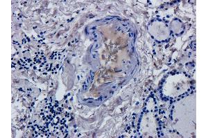 Immunohistochemical staining of human thyroid cancer using anti-CD52 antibody  Formalin fixed human thyroid cancer slices were were stained with a  at 5 µg/ml. (Recombinant CD52 抗体)
