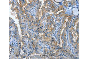 Immunohistochemistry of Human lung cancer using MUC15 Polyclonal Antibody at dilution of 1:50 (MUC15 抗体)