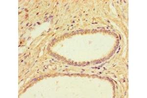 Immunohistochemistry of paraffin-embedded human prostate cancer using ABIN7157778 at dilution of 1:100 (IL4I1 抗体  (AA 139-339))