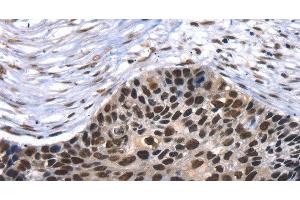 Immunohistochemistry of paraffin-embedded Human esophagus cancer using TAF15 Polyclonal Antibody at dilution of 1:35 (TAF15 抗体)