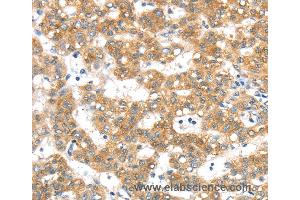 Immunohistochemistry of Human lung cancer using PTPN4 Polyclonal Antibody at dilution of 1:40 (PTPN4 抗体)