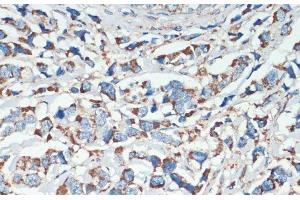 Immunohistochemistry of paraffin-embedded Human breast cancer using APC Polyclonal Antibody at dilution of 1:200 (40x lens). (APC 抗体)