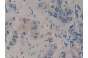 Detection of IGF1 in Human Breast cancer Tissue using Polyclonal Antibody to Insulin Like Growth Factor 1 (IGF1)