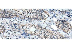 Immunohistochemistry of paraffin-embedded Human cervical cancer tissue using WDFY2 Polyclonal Antibody at dilution of 1:40(x200) (WDFY2 抗体)