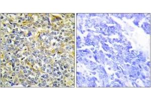 Immunohistochemistry analysis of paraffin-embedded human lung carcinoma tissue, using TFIP8 Antibody. (Cytokeratin 5 抗体  (AA 31-80))