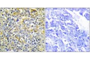 Immunohistochemistry analysis of paraffin-embedded human lung carcinoma tissue, using TFIP8 Antibody.
