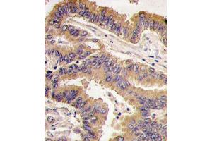 Formalin-fixed and paraffin-embedded human lung carcinoma tissue reacted with GDF5 antibody (N-term), which was peroxidase-conjugated to the secondary antibody, followed by DAB staining. (GDF5 抗体  (N-Term))