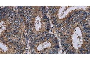 Immunohistochemistry of paraffin-embedded Human colon cancer tissue using NECTIN3 Polyclonal Antibody at dilution 1:40 (nectin-3 抗体)