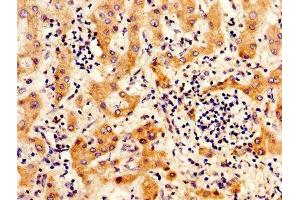 IHC image of ABIN7156517 diluted at 1:300 and staining in paraffin-embedded human liver cancer performed on a Leica BondTM system. (ITIH4 抗体  (AA 689-930))