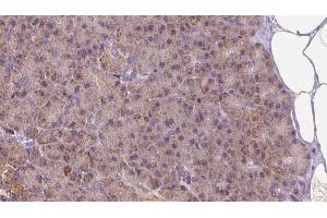 ABIN6273261 at 1/100 staining Human pancreas cancer tissue by IHC-P.