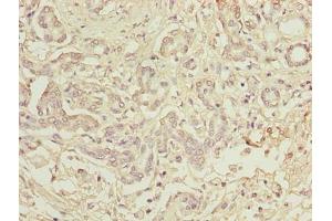 Immunohistochemistry of paraffin-embedded human pancreatic cancer using ABIN7173742 at dilution of 1:100 (TBCC 抗体  (AA 2-346))