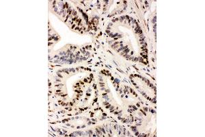 Anti-IRF1 antibody, IHC(P) IHC(P): Human Intestinal Cancer Tissue (IRF1 抗体  (Middle Region))