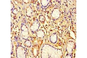 Immunohistochemistry of paraffin-embedded human gastric cancer using ABIN7176457 at dilution of 1:100 (ZNF627 抗体  (AA 1-300))