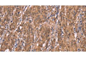 Immunohistochemistry of paraffin-embedded Human gasrtic cancer tissue using FBXO31 Polyclonal Antibody at dilution 1:40 (FBXO31 抗体)
