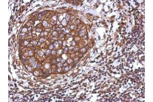 IHC-P Image Immunohistochemical analysis of paraffin-embedded human breast cancer, using TRIM25, antibody at 1:500 dilution. (TRIM25 抗体)