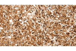 Immunohistochemistry of paraffin-embedded Human prostate cancer using RBM5 Polyclonal Antibody at dilution of 1:30 (RBM5 抗体)