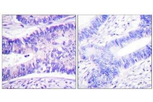 Immunohistochemistry analysis of paraffin-embedded human colon carcinoma tissue using WAVE1 (Phospho-Tyr125) antibody. (WASF1 抗体  (pTyr125))