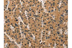 The image on the left is immunohistochemistry of paraffin-embedded Human liver cancer tissue using ABIN7190457(DEFA1/3 Antibody) at dilution 1/30, on the right is treated with synthetic peptide. (DEFA1/DEFA3 抗体)