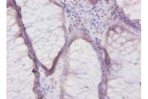 Immunohistochemistry of paraffin-embedded human colon cancer using ABIN7145472 at dilution of 1:50 (beta Defensin 1 抗体  (AA 33-68))