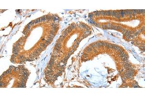 Immunohistochemistry of paraffin-embedded Human colon cancer using ACOT11 Polyclonal Antibody at dilution of 1:40 (ACOT11 抗体)