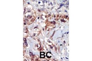 Formalin-fixed and paraffin-embedded human cancer tissue reacted with the primary antibody, which was peroxidase-conjugated to the secondary antibody, followed by AEC staining. (PIP4K2A 抗体  (C-Term))